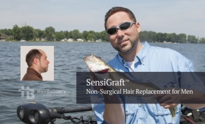 Non-surgical hair replacement men vermont