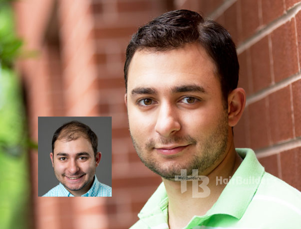 mens hair loss restoration burlington vermont