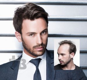 hair restoration men williston vt