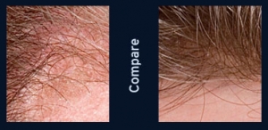 mens hair restoration vermont