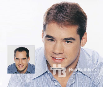 hairbuilders burlington hair replacement men