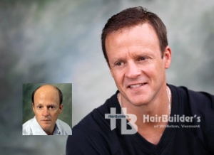 Mens hair loss solutions. Burlington Vermont