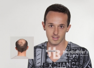 Non-surgical hair replacement. Burlington VT