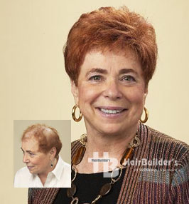 Womens hair loss solutions, burlington vermont