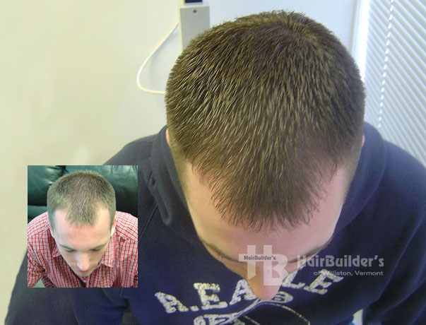 laser hair loss treatment regrowth burlington vt