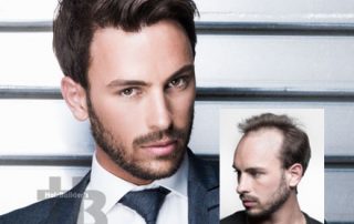 hair restoration men williston vt