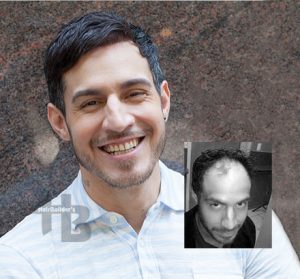 male hair loss replacement vermont