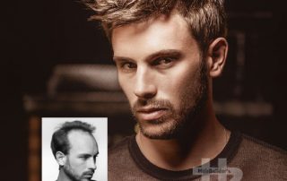 mens non-surgical hair replacement burlington vermont