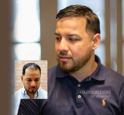 burlington-vt-hair-replacement burlington vermont mens hair loss replacement restoration