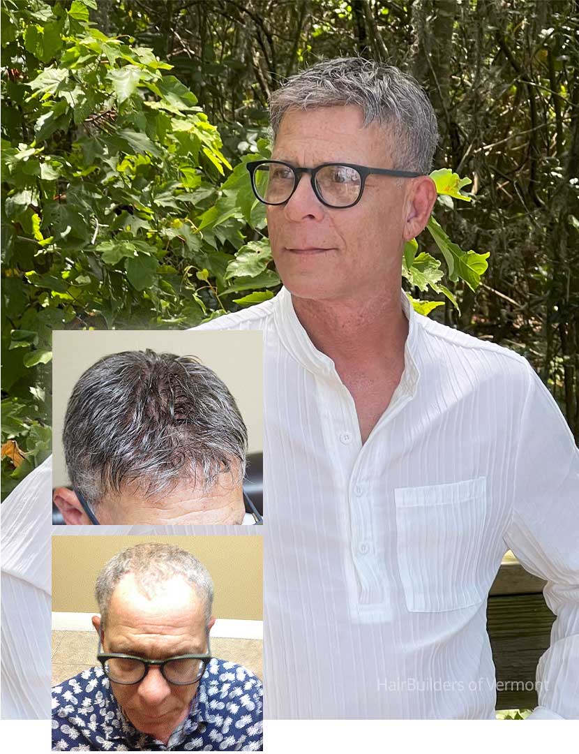 Custom-Mens-Hair-Replacement-Results-Hairbuilders-of-Vermont-Williston-VT custom mens hair replacement results hairbuilders williston vermont