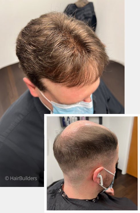 HairBuilders-custom-mens-hair-replacement-results-Vermont hairbuilders custom mens hair replacement results vermont