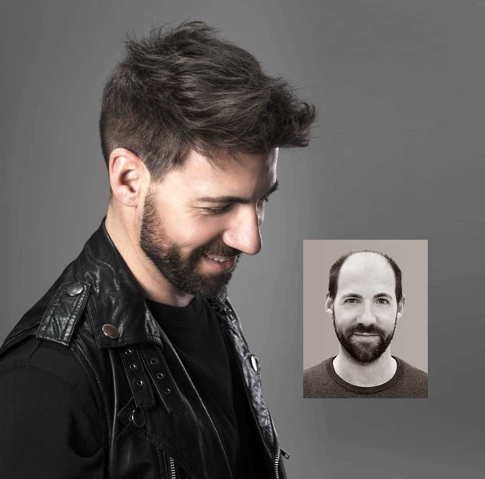 Hairskeen hair replacement Vermont