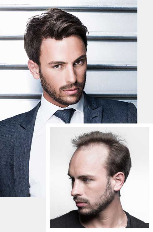 non-surgical mens hair replacement specialists williston burlington stowe vermont