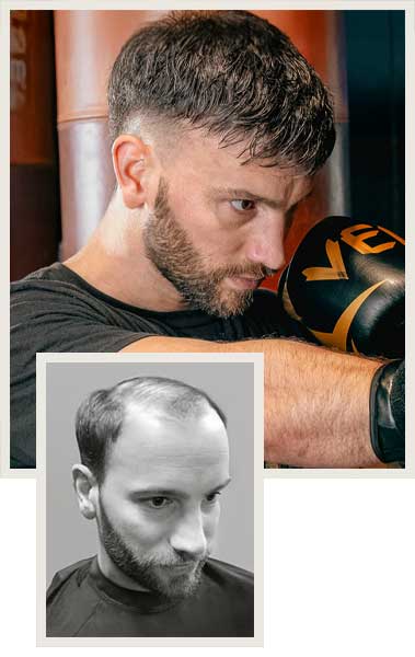 mens non-surgical hair replacement specialists burlington vermont