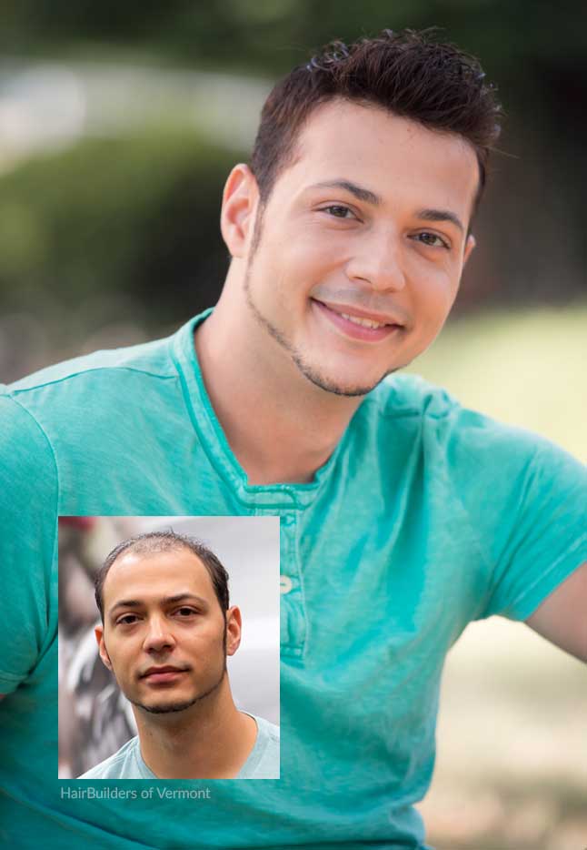 mens-non-surgical-hair-replacement-specialists-burlington-williston-plattsburg-stowe mens non surgical hair replacement specialists burlington williston plattsburg stowe