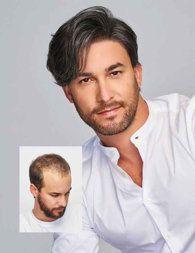 mens-non-surgical-hair-replacement-williston-vermontjpg mens non-surgical hair replacement williston vermont