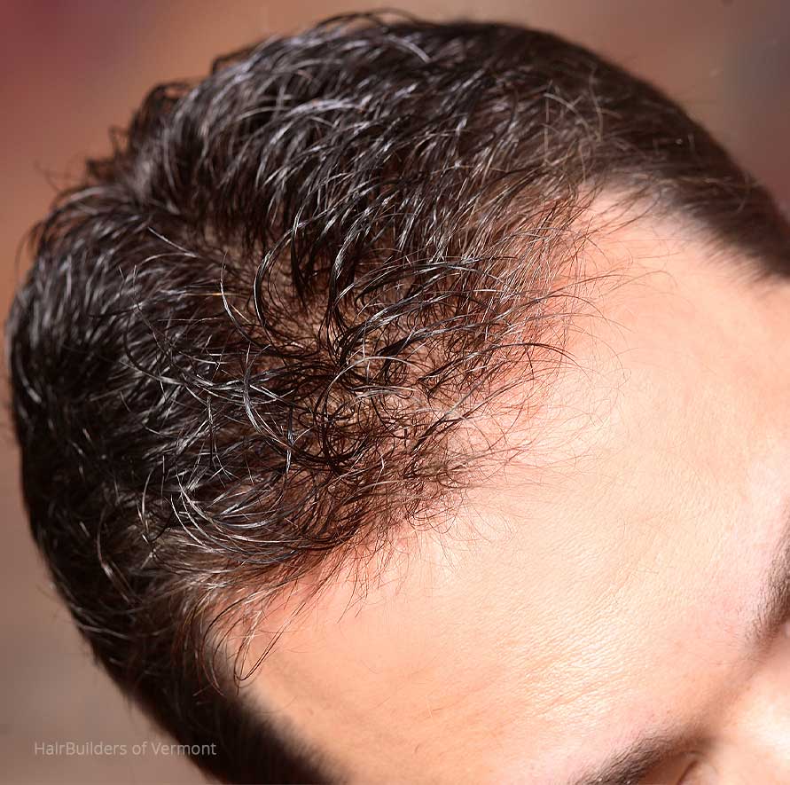 custom-mens-hair-restoration-williston-burlington-vermont-at-HairBuilders men's hair restoration specialists williston vermont