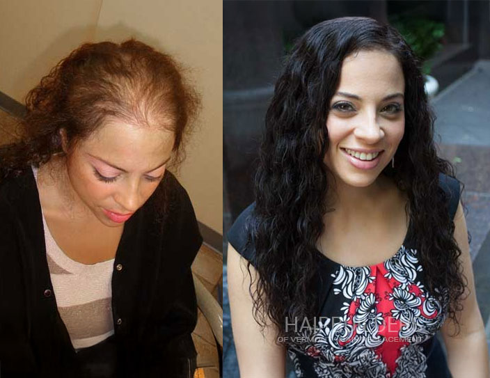 hair-replacement-for-female-hair-loss-burlington-vermont-hairbuilders hair replacement for female hair loss burlington vermont hairbuilders