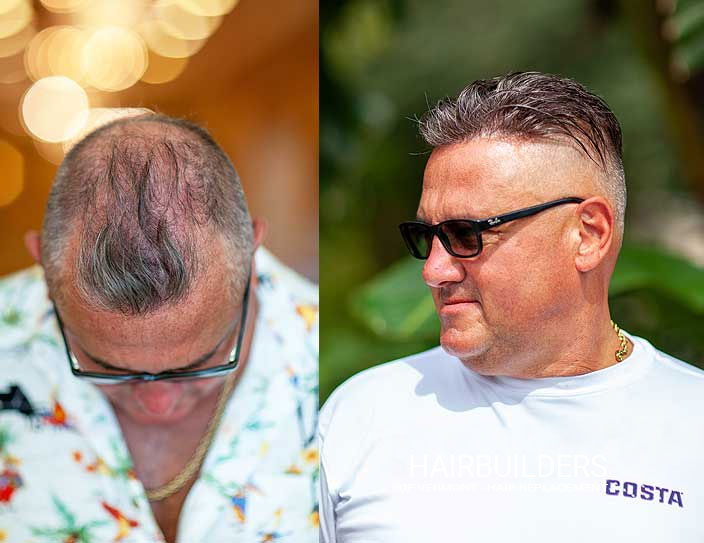 mens-non-surgical-hair-loss-solutions-results-at-HairBuilders-in-Williston-VT hair replacement for male pattern baldness burlington vermont hairbuilders