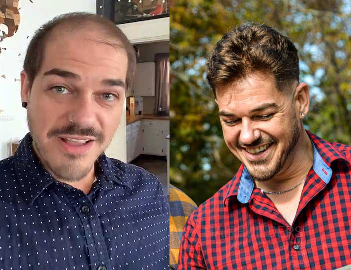 mens-non-surgical-hair-replacement-at-HairBuilders-in-Williston-VT men's non-surgical hair replacement at HairBuilders in Williston VT