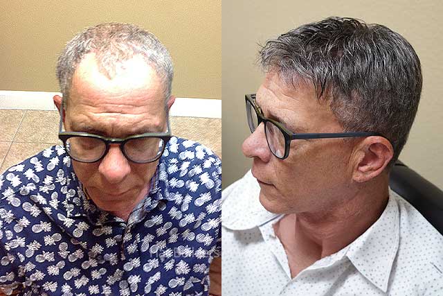HairBuilders-of-Vermont-mens-custom-hair-replacement-systems Hairbuilders of Vermont - Custom hair systems for men
