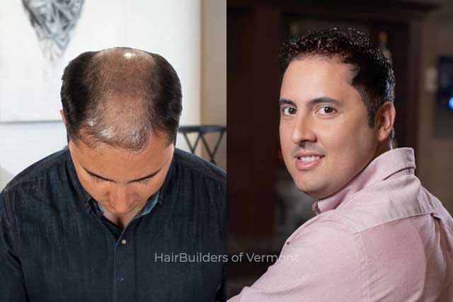 custom-mens-non-surgical-hair-replacement-Vermont-HairBuilders-Williston custom hair systems for men at HairBuilders in Williston VT Stowe Manchester Platsburgh