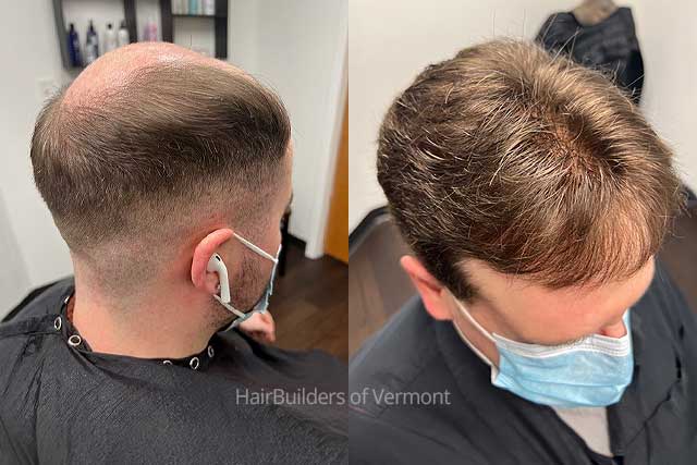 mens-custom-hair-replacement-systems-HairBuilders-Williiston-VT mens custom hair replacement systems hairbuilders vermont