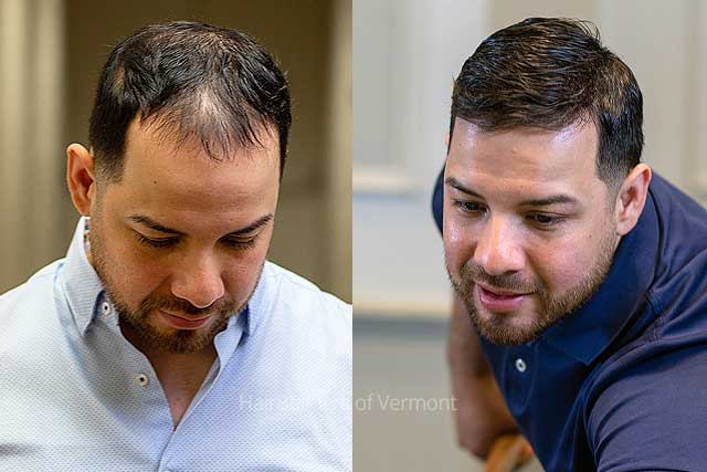 mens custom hair systems vermont mens custom hair systems vermont