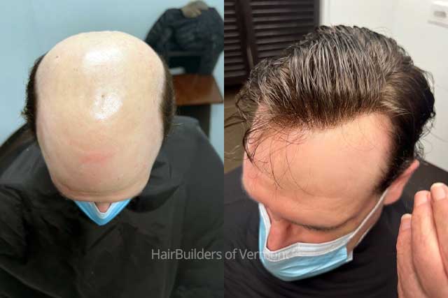 mens-non-surgical-hair-restoration-HairBuilders-Vermont-Northern-NY mens non-surgical hair restoration vermont and northern new york