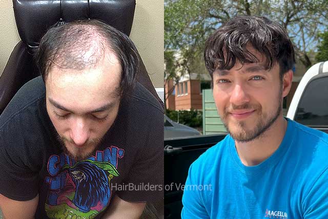 non-surgical-mens-hair-restoration-williston-vermont-potsdam-ny mens non-surgical hair restoration HairBuilders vermont Northern NY